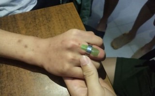 做戒指短视频剪辑 果然视频男子被戒指“咬”住手指，消防员剪切二十分钟帮其脱困